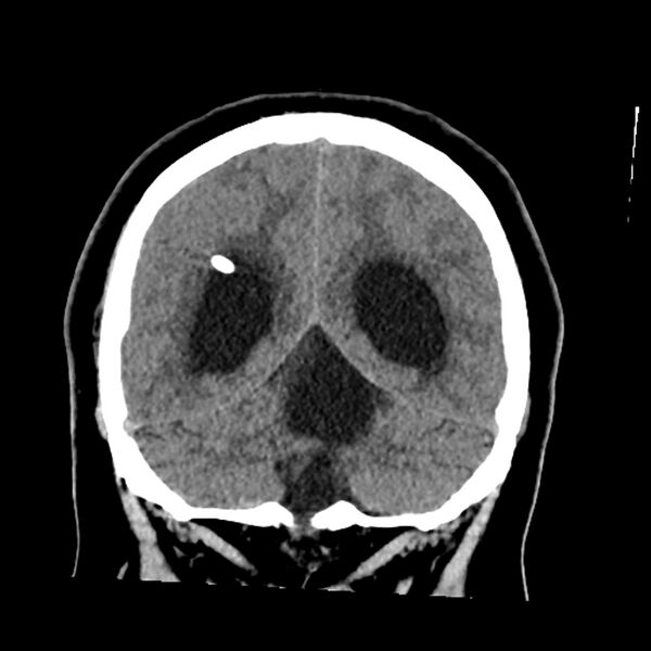 File:Chiasmatic-hypothalamic juvenile pilocytic astrocytoma (Radiopaedia 78533-91237 Coronal non-contrast 52).jpg