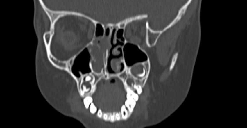 Choanal atresia (Radiopaedia 51295-56972 Coronal bone window 39).jpg