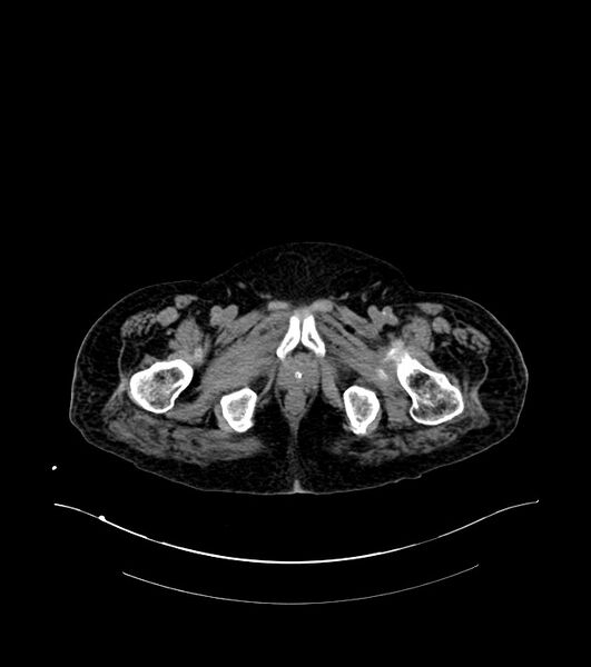 File:Cholangiocarcinoma with cerebral metastases (Radiopaedia 83519-98629 Axial non-contrast 130).jpg