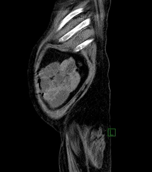 File:Cholangiocarcinoma with cerebral metastases (Radiopaedia 83519-98629 F 14).jpg