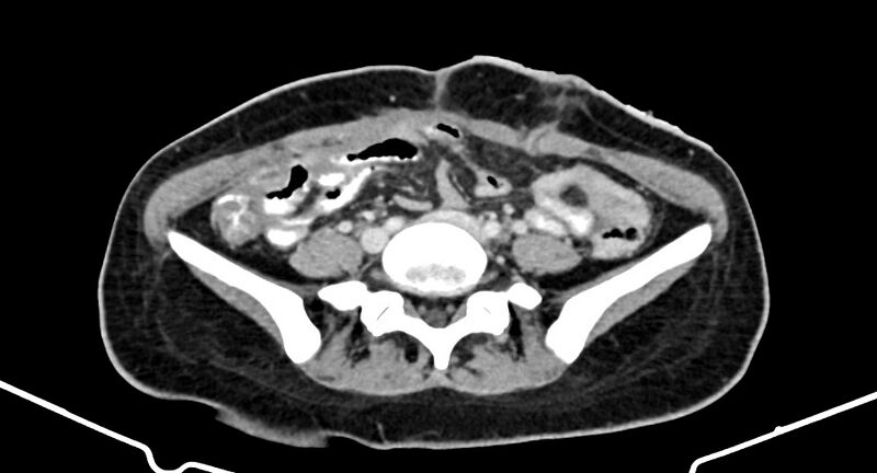 File:Choriocarcinoma liver metastases (Radiopaedia 74768-85766 A 140).jpg