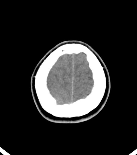 File:Choroid plexus carcinoma (Radiopaedia 91013-108552 Axial non-contrast 55).jpg