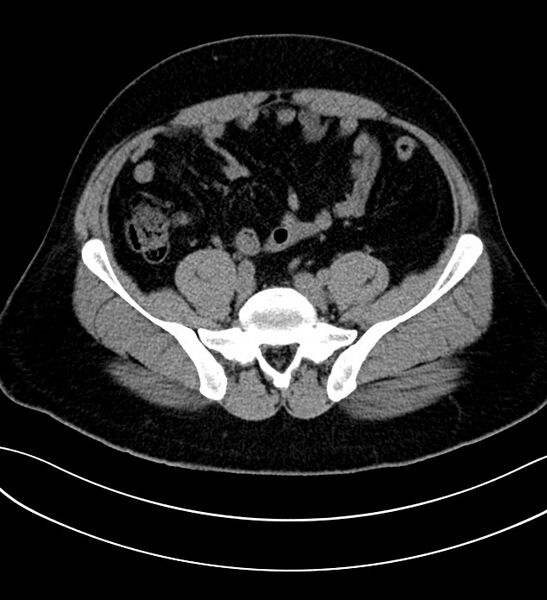 File:Chromophobe renal cell carcinoma (Radiopaedia 84286-99573 Axial non-contrast 44).jpg