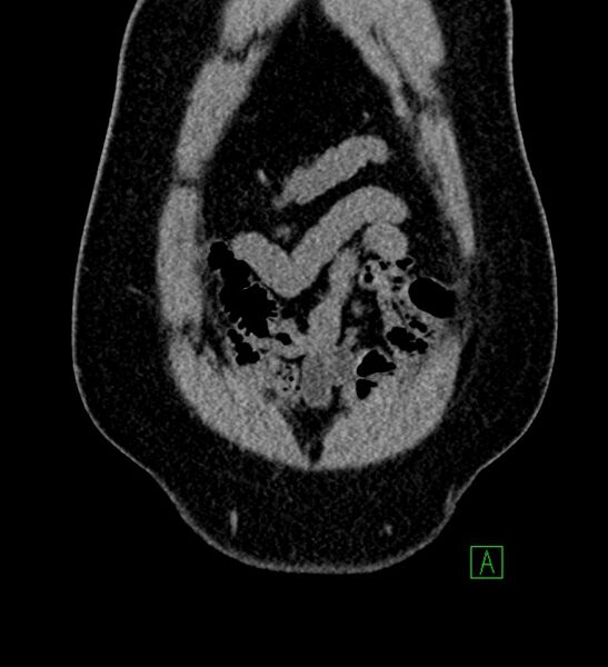 File:Chromophobe renal cell carcinoma (Radiopaedia 84286-99573 Coronal non-contrast 18).jpg