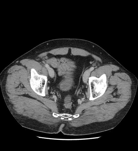 File:Chromophobe renal cell carcinoma (Radiopaedia 86879-103083 C 136).jpg