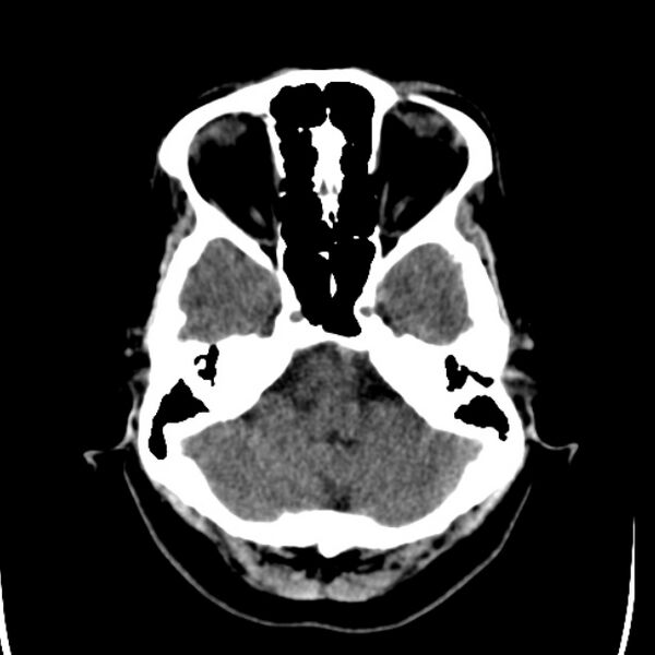 File:Chronic bilateral occipital lobe infarcts (Radiopaedia 31276-31996 Axial non-contrast 9).jpg