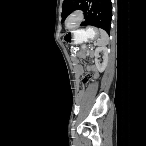 File:Chronic pancreatitis (Radiopaedia 21022-20949 D 6).jpg