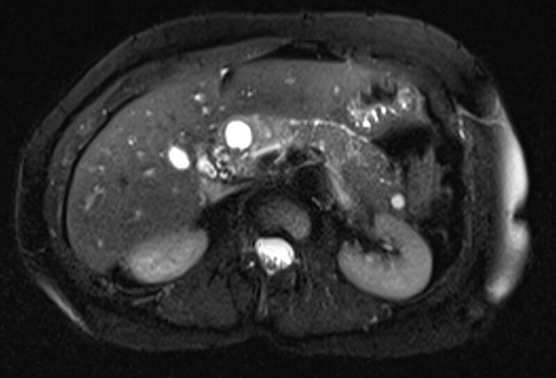 File:Chronic pancreatitis - pancreatic duct calculi (Radiopaedia 71818-82250 Axial T2 fat sat 25).jpg