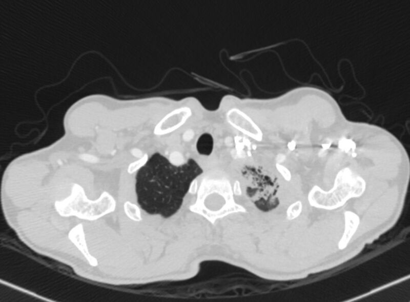 File:Chronic pulmonary embolism with bubbly consolidation (Radiopaedia 91248-108850 Axial lung window 6).jpg