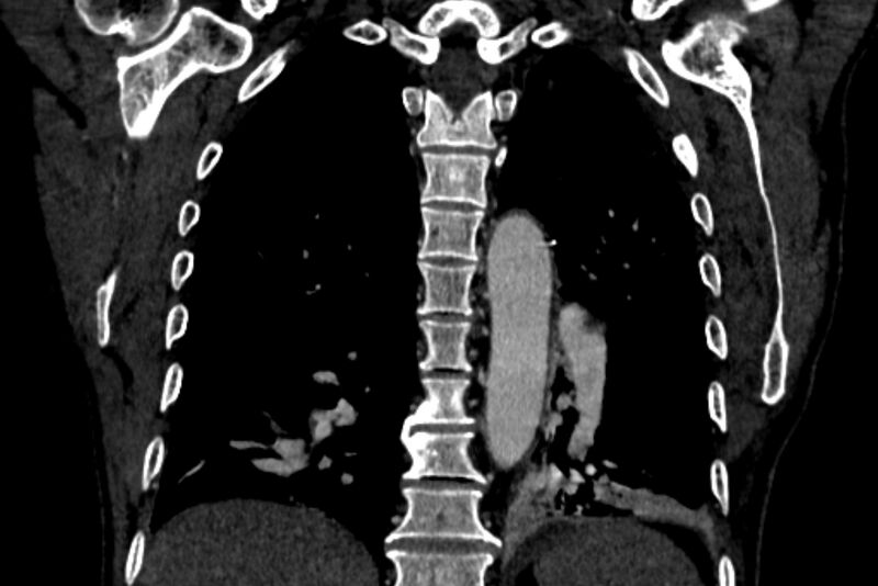 File:Chronic pulmonary embolism with bubbly consolidation (Radiopaedia 91248-108850 B 102).jpg