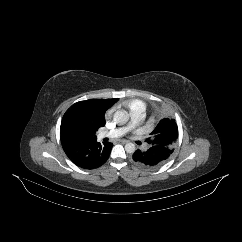Chronic thromboembolic pulmonary hypertension (CTEPH) (Radiopaedia 74597-85532 Axial C+ CTPA 90).jpg
