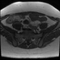 Class II Mullerian duct anomaly- unicornuate uterus with rudimentary horn and non-communicating cavity (Radiopaedia 39441-41755 Axial T1 5).jpg