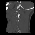 Clay-shoveler fracture (Radiopaedia 22568-22590 Sagittal bone window 3).jpg