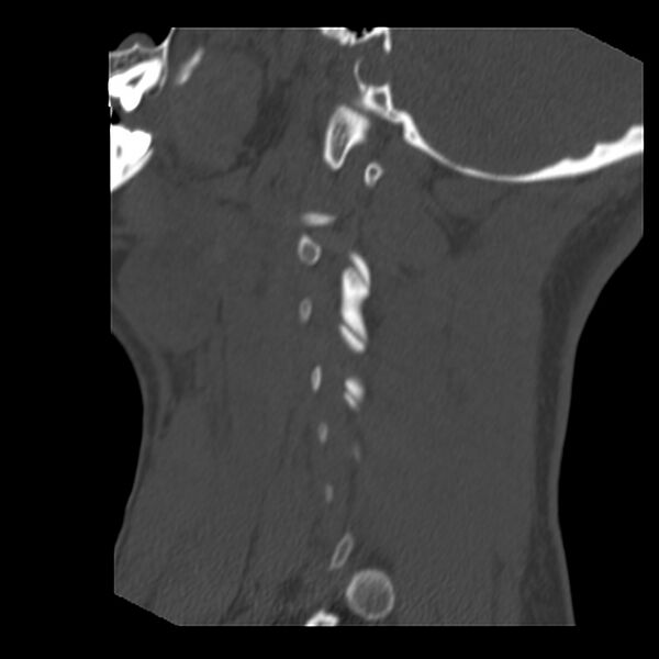 File:Clay-shoveler fracture (Radiopaedia 22568-22590 Sagittal bone window 3).jpg