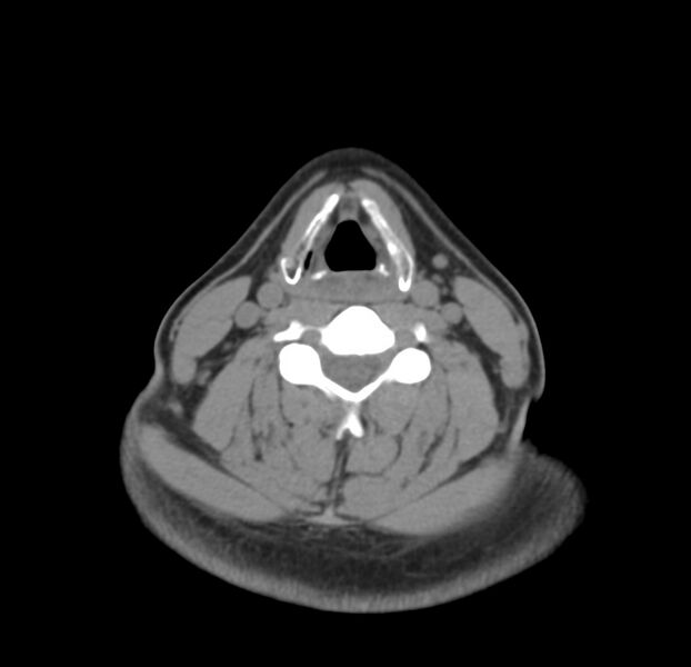 File:Colloid cyst of thyroid (Radiopaedia 22897-22923 Axial non-contrast 30).jpg
