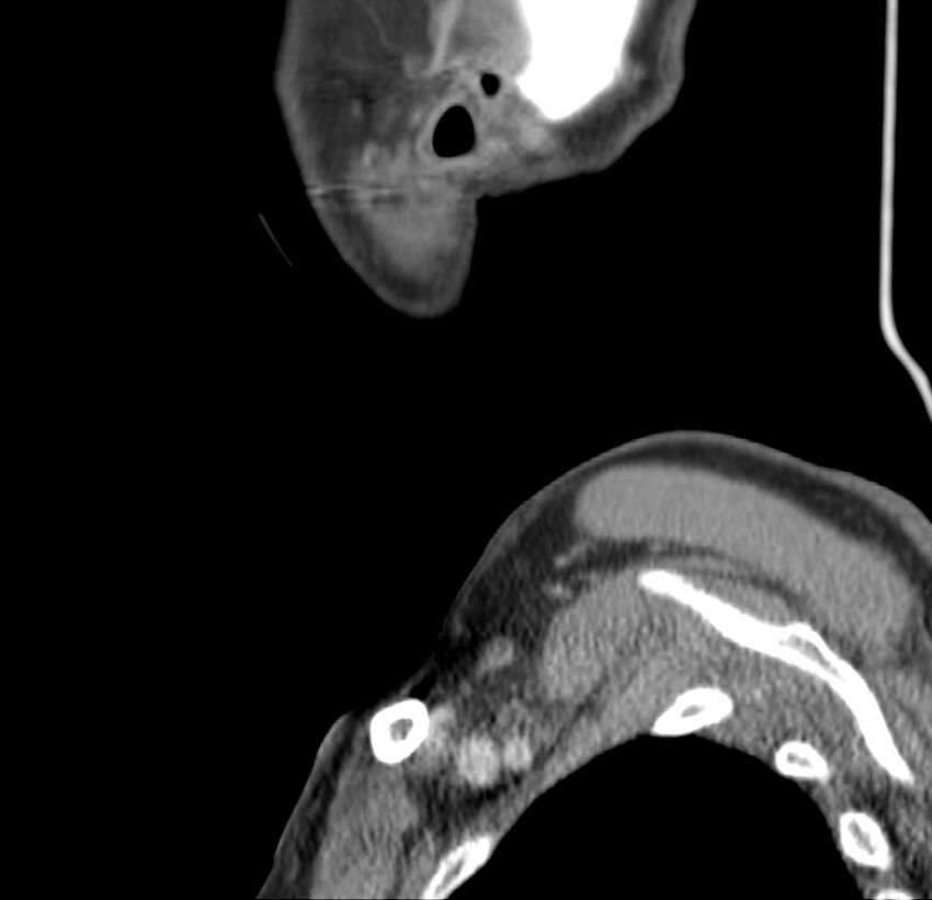 Colloid cyst of thyroid (Radiopaedia 22897-22923 Sagittal C+ delayed 55).jpg