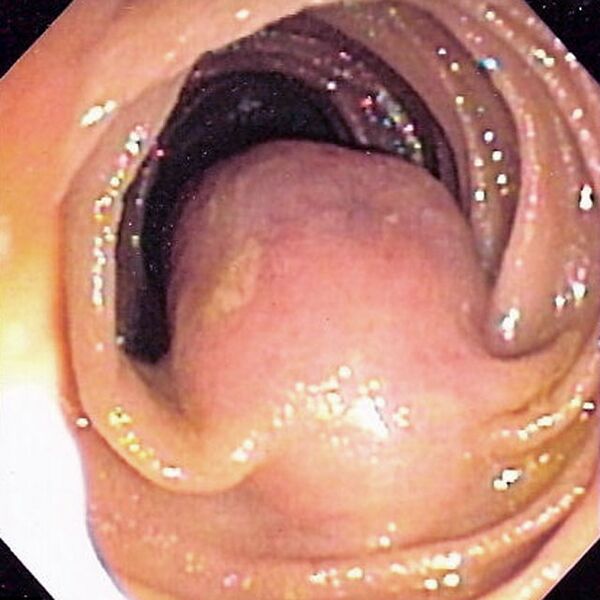 File:Jejunal gastrointestinal stromal tumor (photo) (Radiopaedia 36401).jpg