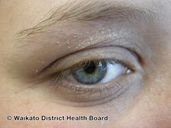 Mild chronic eyelid dermatitis