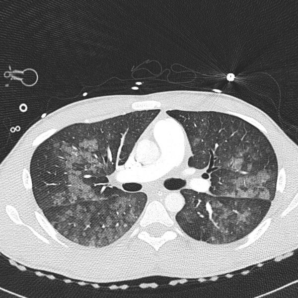 File:Near drowning (pulmonary edema) (Radiopaedia 24685-24958 lung window 19).jpg
