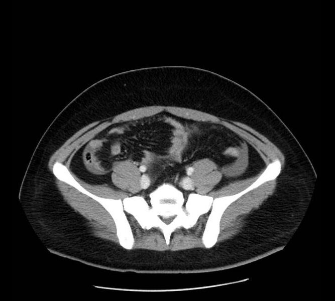 File:Necrotizing pancreatitis (Radiopaedia 23001-23031 A 63).jpg