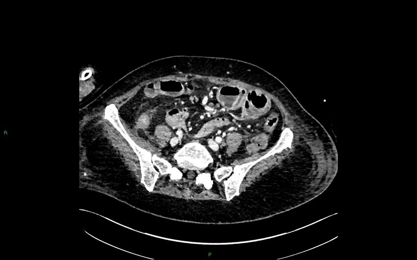 Neo-terminal ileal stricture (Crohn disease) (Radiopaedia 33790-34948 A 326).jpg