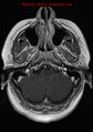 Neuroglial cyst (Radiopaedia 10713-11184 Axial T1 C+ 20).jpg