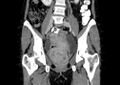 Non-puerperal uterine inversion (Radiopaedia 78343-91094 B 8).jpg