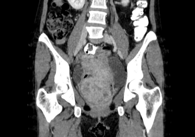 File:Non-puerperal uterine inversion (Radiopaedia 78343-91094 B 8).jpg
