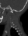 Normal CT cervical spine - pediatric (Radiopaedia 52549-58462 Sagittal bone window 19).jpg