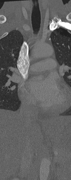 File:Normal CT thoracic spine (Radiopaedia 40181-42688 Coronal bone window 6).png