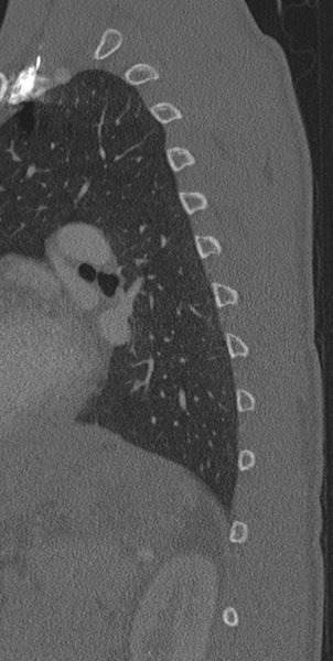 File:Normal CT thoracic spine (Radiopaedia 40181-42688 Sagittal bone window 8).png