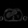Normal MRI abdomen in pregnancy (Radiopaedia 88001-104541 D 5).jpg