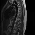 Normal cervical and thoracic spine MRI (Radiopaedia 35630-37156 I 3).png