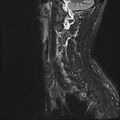 Normal cervical spine MRI (Radiopaedia 38418-40496 Sagittal STIR 3).jpg