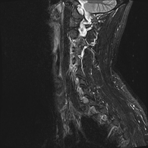 File:Normal cervical spine MRI (Radiopaedia 38418-40496 Sagittal STIR 3).jpg