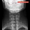Normal cervical spine radiographs (Radiopaedia 32505-96697 B 7).jpeg