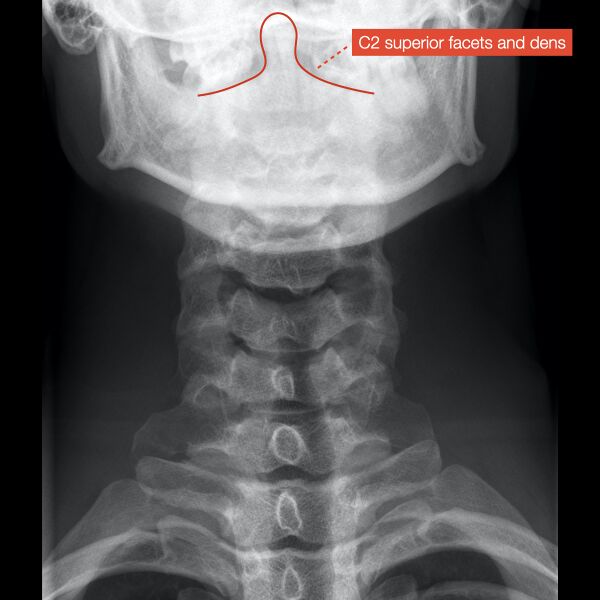 File:Normal cervical spine radiographs (Radiopaedia 32505-96697 B 7).jpeg