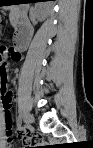 File:Normal lumbar spine CT (Radiopaedia 46533-50986 C 73).png