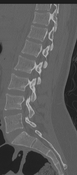 File:Normal lumbosacral CT (Radiopaedia 37923-39867 Sagittal bone window 56).png
