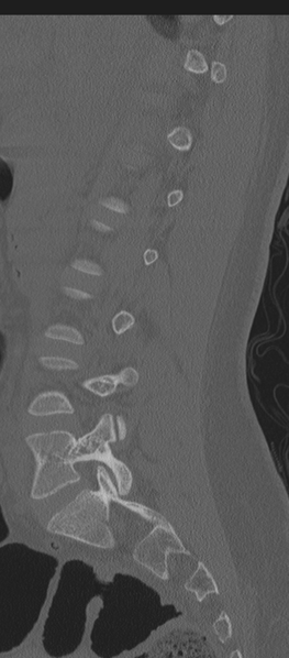 File:Normal lumbosacral CT (Radiopaedia 37923-39867 Sagittal bone window 63).png
