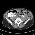 Normal multiphase CT liver (Radiopaedia 38026-39996 Axial non-contrast 55).jpg