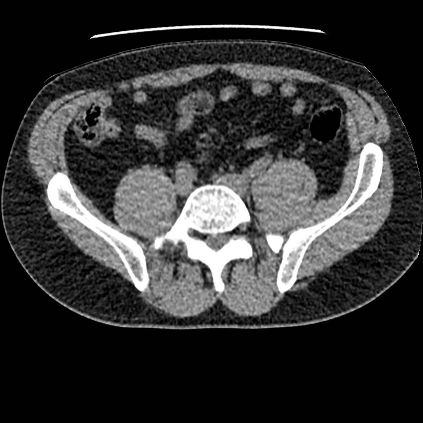 Obstructing ureteric calculus and ureteric anatomy (Radiopaedia 62730-71042 Axial non-contrast 103).jpg