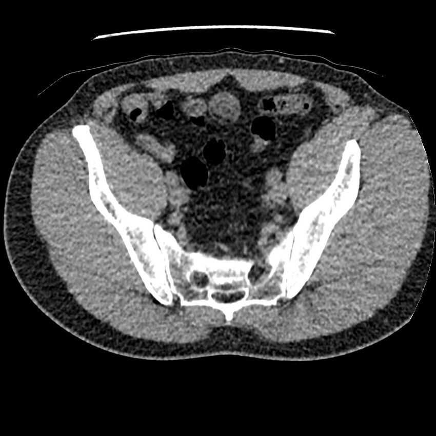 Obstructing ureteric calculus and ureteric anatomy (Radiopaedia 62730-71042 Axial non-contrast 131).jpg