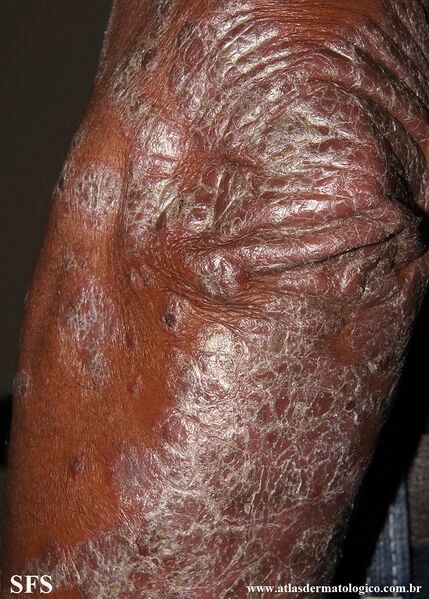 File:Psoriasis (Dermatology Atlas 142).jpg