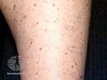 See more images of lentigines... (DermNet NZ lesions-lentigo5).jpg