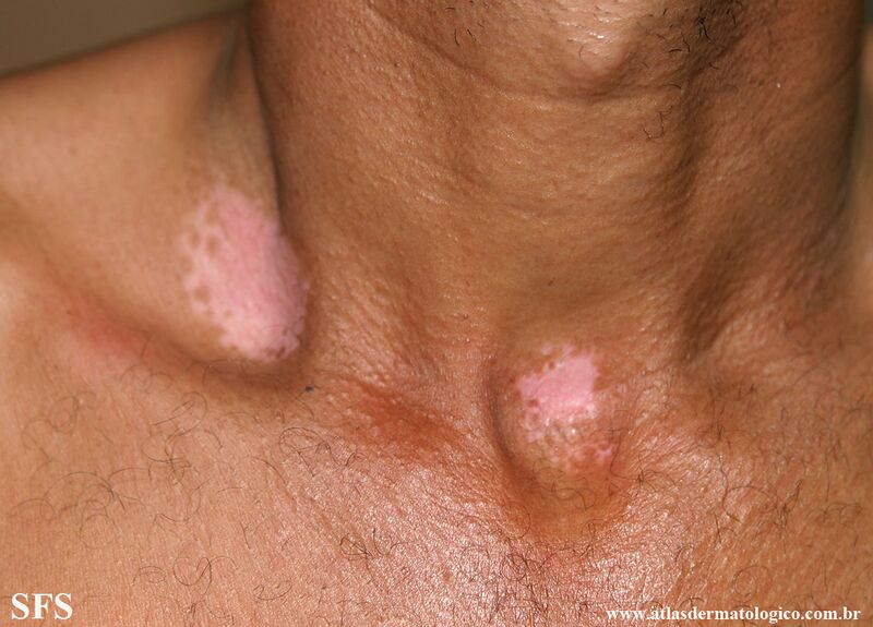 File:Vitiligo (Dermatology Atlas 62).jpg