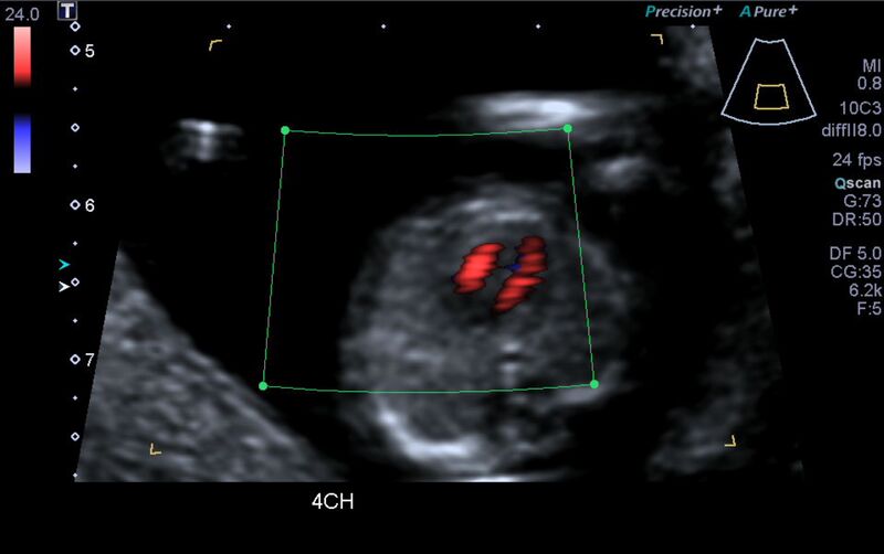 File:1st trimester nuchal-morphology ultrasound (Radiopaedia 44706-48477 Heart views cine with colour 9).jpg