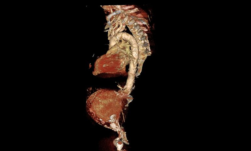 File:Abdominal aortic aneurysm- extremely large, ruptured (Radiopaedia 19882-19921 3D 9).jpg