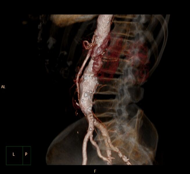 File:Abdominal aortic aneurysm (Radiopaedia 23703-23856 3D 18).jpg