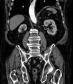 Abdominal aortic aneurysm (Radiopaedia 25855-26001 Coronal C+ arterial phase 50).jpg